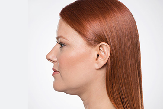 Front Before